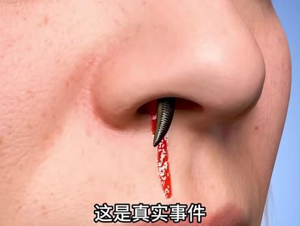 水蛭寄生在身体里会发生什么?#科普一下 #涨知识