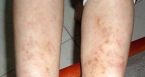 狗狗血管炎——宠物健康隐患（预防和治疗血管炎的措施）