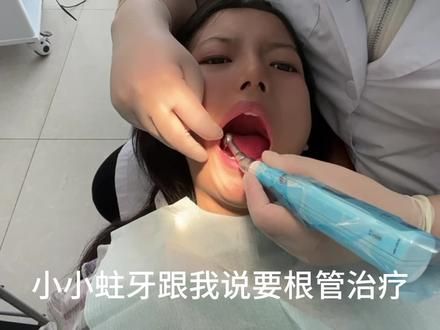 根管治疗你就做吧 一做一个不吱声#dou上热门 #根管治疗 #补牙