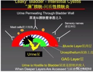 间质性膀胱炎
