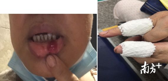 陈小姐父母身上被擦伤。