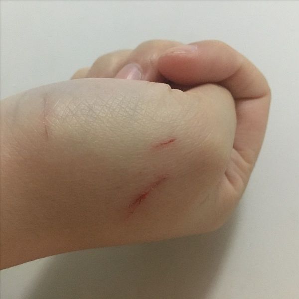 刚愈合就又咬开了