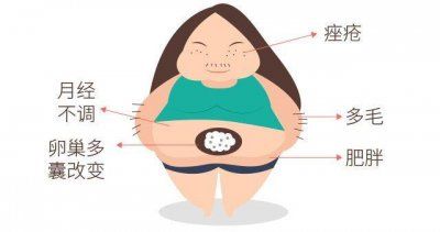 梁婉迪医生讲述多囊卵巢综合症的症状和治疗