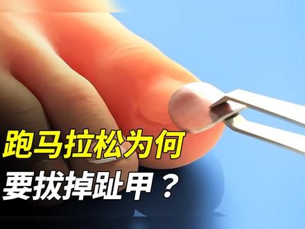 跑马拉松为什么要拔掉脚趾甲? #冷知识 #指甲 #科普一下 #涨知识