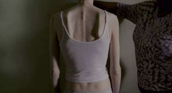 2017年上映的美国电影《骨瘦如柴》,讲述了患有厌食症的女子在医生激励下,直视疾病与其斗争的故事。电影的导演马蒂·诺克森曾一度厌食到心脏骤停,女主角莉莉·柯林斯也曾患有厌食症。电影剧照