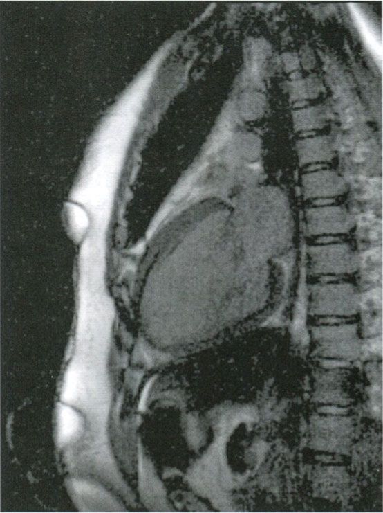 核磁共振检查,磁共振显像,MRI,心脏病,冠心病,冠状动脉,心肌病,冠状动脉造影,博声医疗