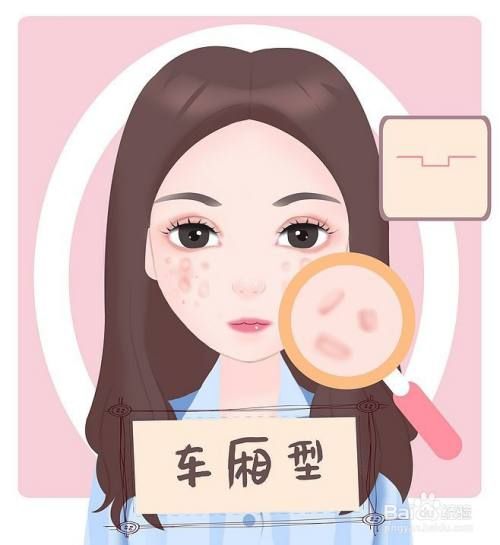 痘坑类型图片
