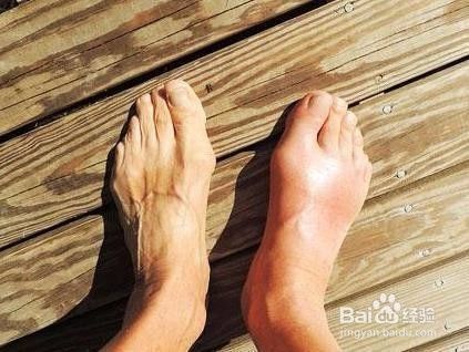 什么原因使类风湿因子高