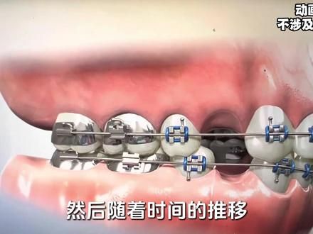 牙齿矫正！ #科普一下 #牙套