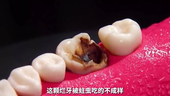 根管治疗 #口腔科普 #六盘水惠诚口腔