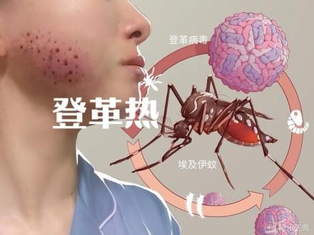 登革热是一种由登革病毒引起的急性虫媒传染病，主要通过埃及伊蚊和白纹伊蚊传播！减少滋生地、控制成蚊、防控登革热！#登革热 #登革热病毒 #科普