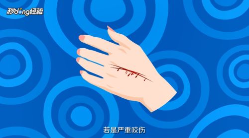 仓鼠咬人了怎么办