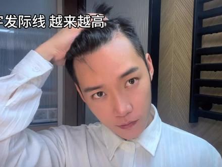 好久不见啊～#拯救发际线 #脱发#恩叔