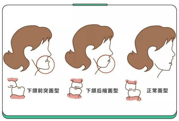 咬合不正宠物-咬合不正常怎么矫正