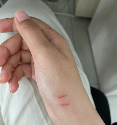 被猫咪抓伤后打针最晚时间是多久？（保护自己和宠物免受疾病侵害）