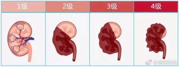 肾衰分级