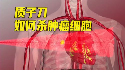 放疗届的天花板，质子刀，它是如何工作的呢？