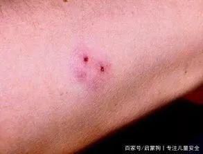 吓人！15岁男孩网购这个当宠物被咬伤，三天才脱离危险！
