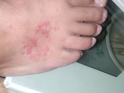 过敏性皮炎脚背有凸起的圆形结节图.jpg