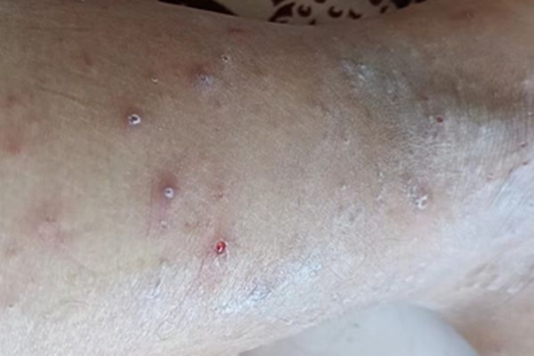 过敏性皮炎脚踝症状图