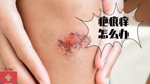 宠物当道 当心爱宠招来皮肤炎