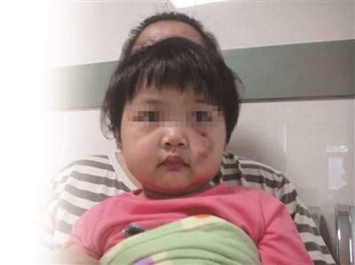 孩被狗咬缝20针 亲近还是远离宠物？
