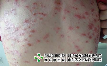食疗怎么治疗银屑病