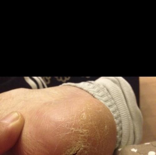 鱼鳞发黑是疾病的表现吗？哪种药膏治疗效果好？