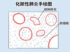 肺炎