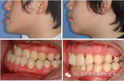 矫正宠物地包天,让笑容更迷人