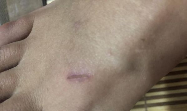 遇到狗狗伤手怎么办？（宠物抓伤手部处理方法和预防措施）