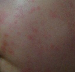 猫抓病症状:抓伤后3-10天,宠物般症状,如发热、淋巴结肿大。