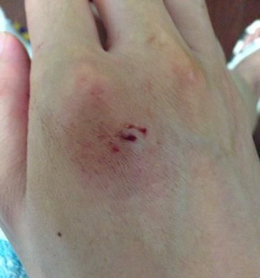 被猫咪抓伤了需要打狂犬疫苗吗？什么情况下需要打？