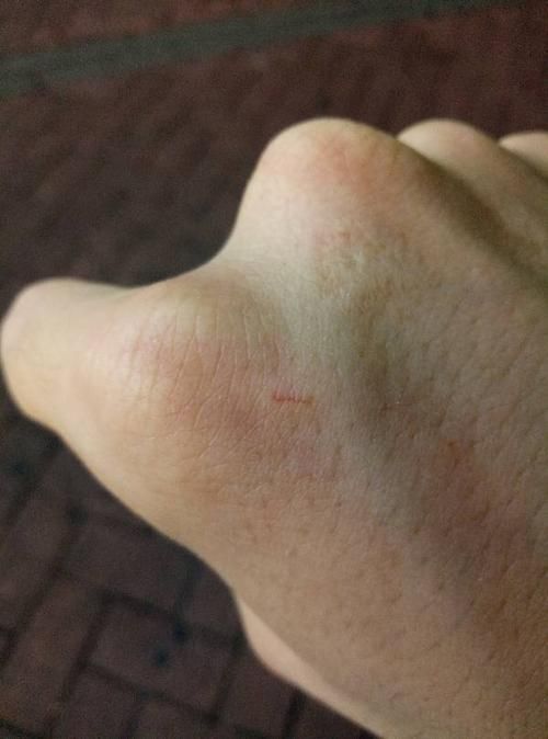 被宠物猫抓伤出了一点点血（被宠物猫抓伤轻微出血）