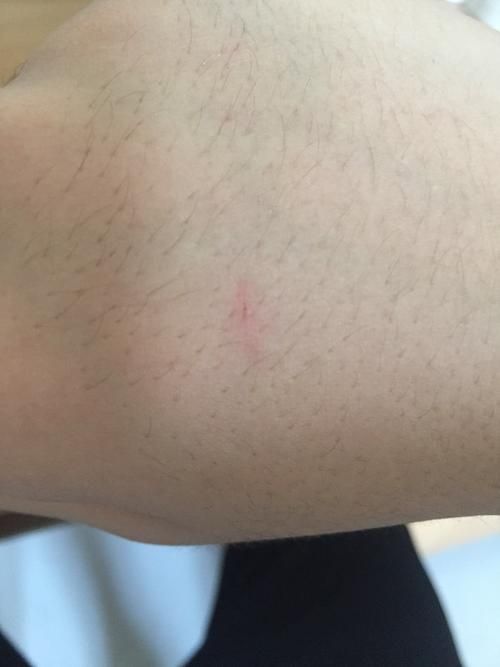 被宠物猫抓伤出了一点点血（被宠物猫抓伤轻微出血）