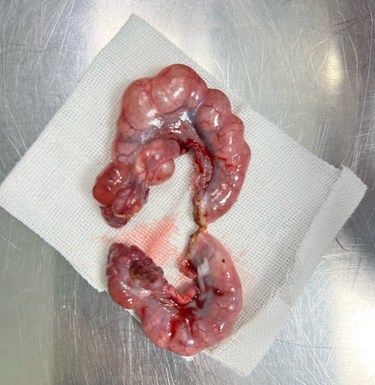 子宫积液