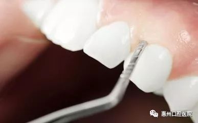 超声波洗牙:宠物牙齿健康,但需注意操作风险。