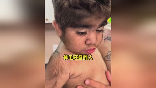 体毛旺盛的烦恼