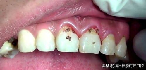 宠物牙结石危害大,预防是关键!