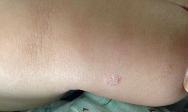 宠物湿疹症状及治疗方法详解（如何预防和缓解宠物湿疹）