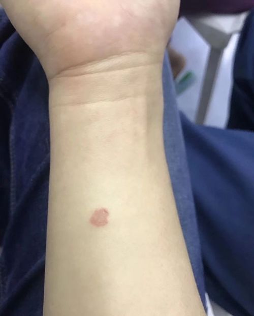 三个月大猫咪抓伤的原因是什么？如何预防与治疗？