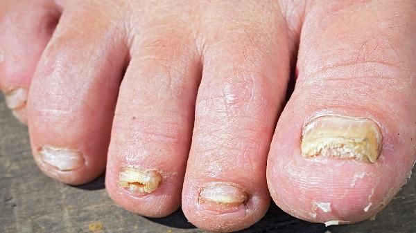 从小手指甲的颜色就是乳白色正常吗