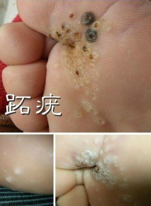 “宠物界的，鸡眼跖疣傻傻分不清楚？”