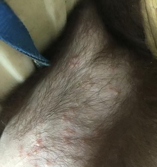 狗狗大腿内侧长痘痘，怎么办？（狗狗皮肤问题解析与处理方法）