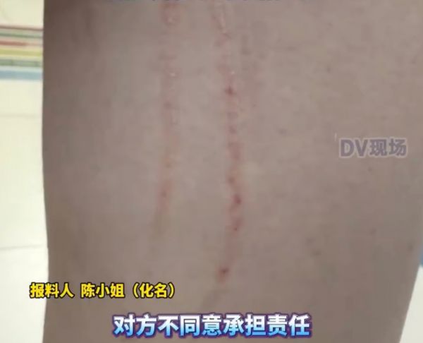 广东一女子在电梯内被邻居的狗抓伤，对方：去告我吧