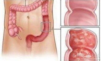 宠物直肠炎,合理用药,饮食调整。