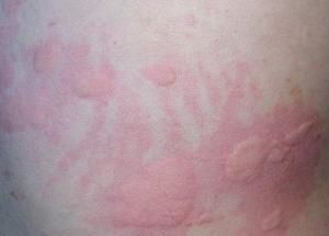 猫患过敏性皮炎，可以用什么药物治疗呢？