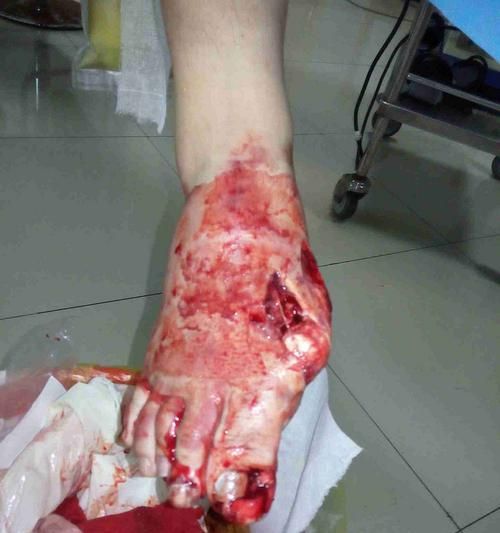 腿部砸伤急救知识大揭秘（应对腿部砸伤，关键救助技巧一网打尽）