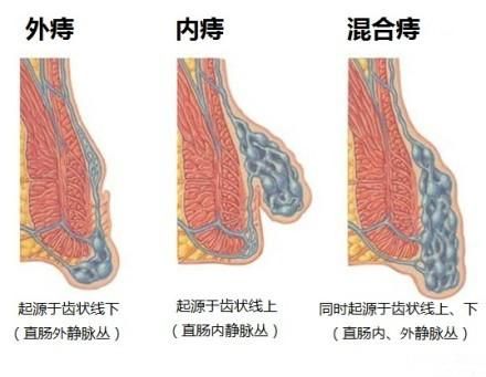 痔疮有哪些种类如何分辨,痔疮的类型有哪些
