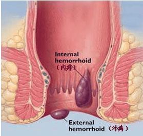 痔疮有哪些种类如何分辨,痔疮的类型有哪些